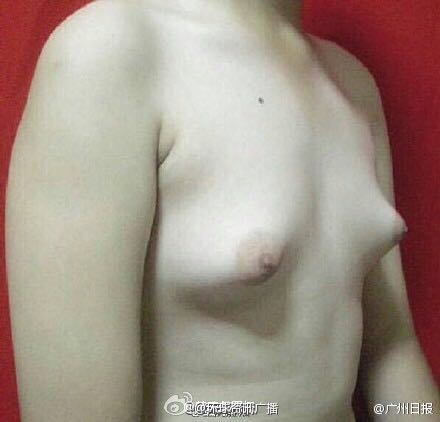 Fried Chicken Makes Man Grow Big Breasts - People's Daily Online