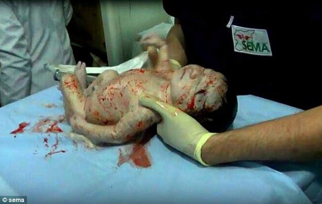 Baby born alive in Syria with shrapnel in her head