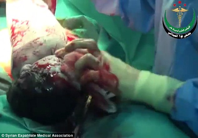 Baby born alive in Syria with shrapnel in her head