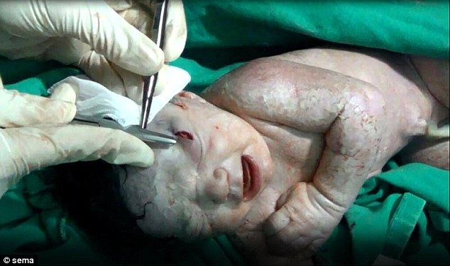 Baby born alive in Syria with shrapnel in her head