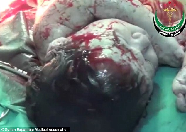 Baby born alive in Syria with shrapnel in her head