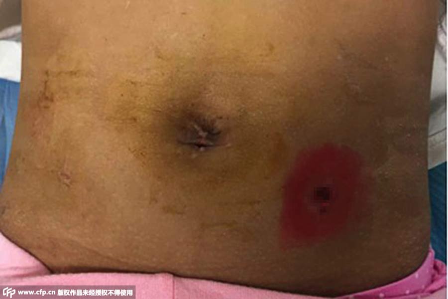 Large “stone” found in stomach of 7-year-old girl who likes eating hair and nails