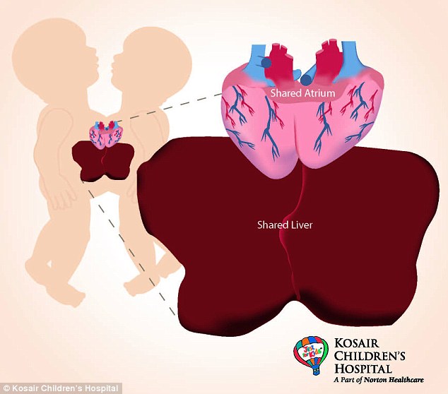 Conjoined twin girls who shared part of their livers and hearts are successfully separated