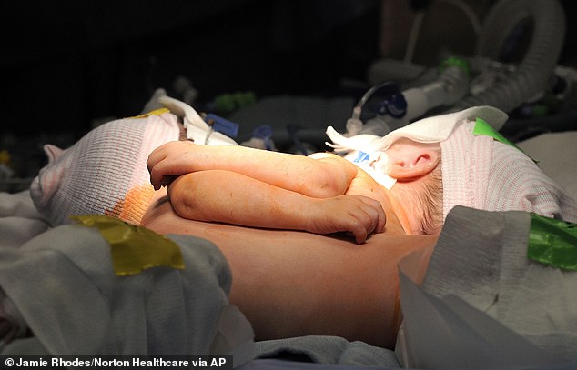 Conjoined twin girls who shared part of their livers and hearts are successfully separated