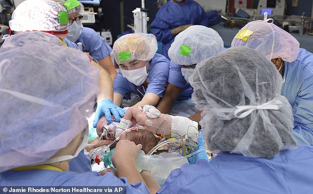 Conjoined twin girls who shared part of their livers and hearts are successfully separated