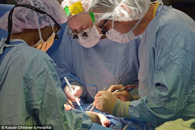 Conjoined twin girls who shared part of their livers and hearts are successfully separated