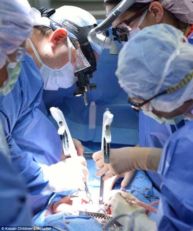 Conjoined twin girls who shared part of their livers and hearts are successfully separated