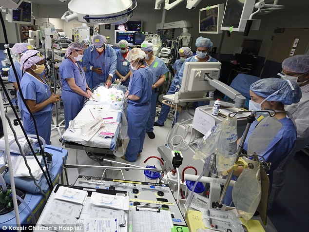 Conjoined twin girls who shared part of their livers and hearts are successfully separated