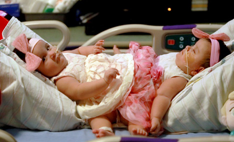 Rare conjoined twin sisters to be separated 