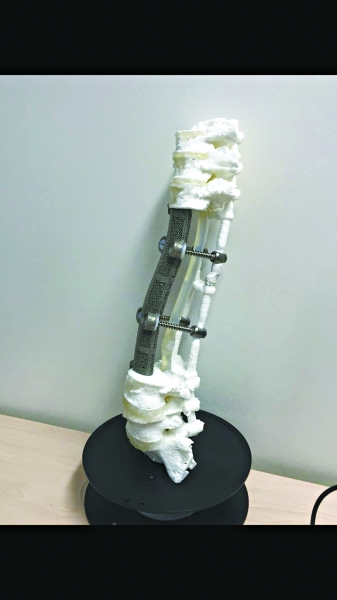 3-D printed spine successfully implanted in man's body in Beijing