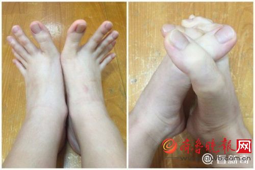 Girl goes viral for finger-long toes