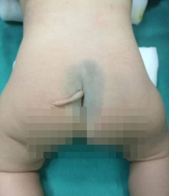 Newborn girl with birth defect has tail surgically removed