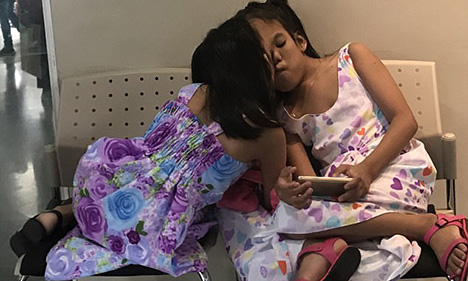 Filipino twins conjoined at forehead to be separated