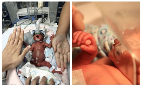 Tiny infant born 12 weeks premature now healthy enough to go home