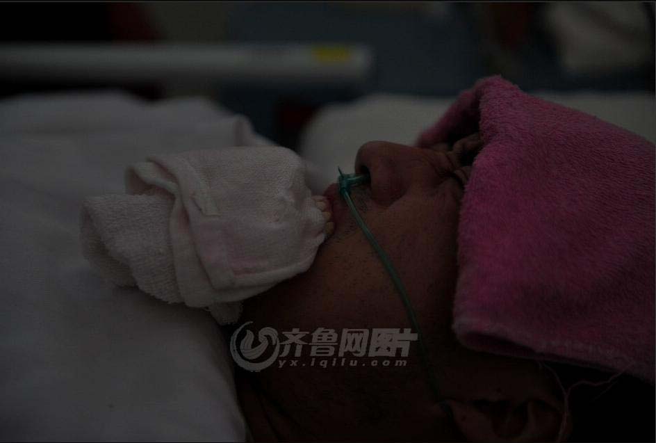 Gong Yuben bites towels for endure the excruciating pain. Several towels have been broken over the past half month since he badly injured. (iqilu.com/Zhang Xiaobo)
