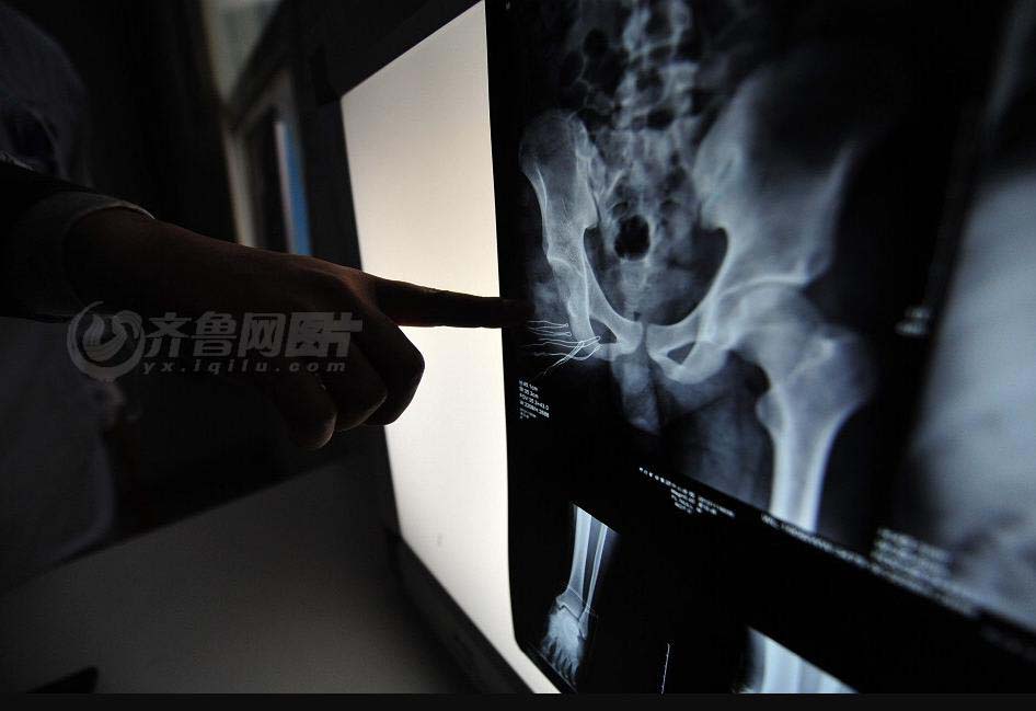 A X-ray film shows Gong Yuben has lost his right leg. (iqilu.com/Zhang Xiaobo)