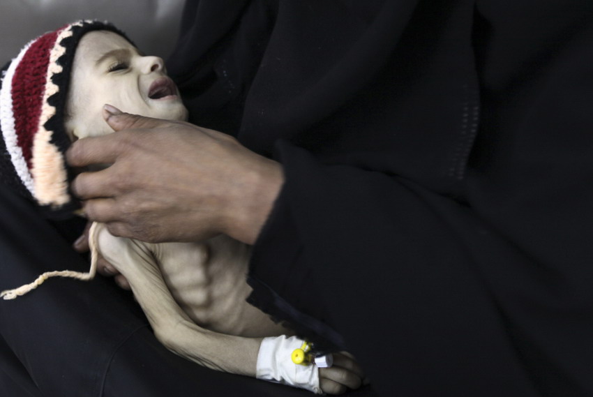 A woman holds her malnourished child at a therapeutic feeding center of a hospital in Sanaa on May 28, 2012. (Reuters /Mohamed al-Sayaghi)