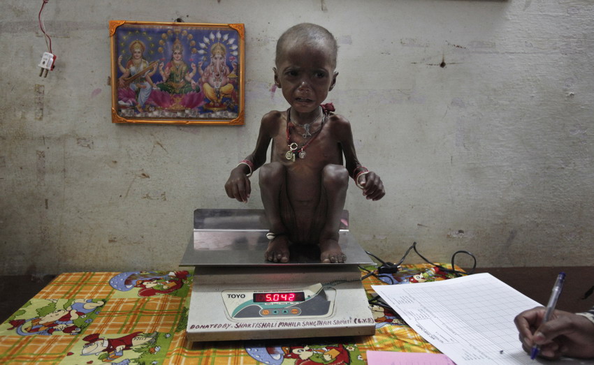 Severely malnourished two-year-old girl Rajini is weighted by a health worker in a nutritional recovery center in centraShivpuri town, India on Feb 1, 2012. (Reuters/Adnan)
