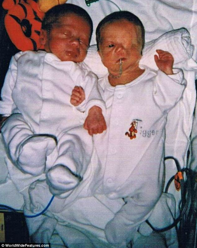 The 33-year-old British mother Charlene Machin had given birth to twin boys Oliver and Harry, but doctors discovered baby Harry had been born with a severe facial deformity, according to newspaper Daily Mail. Charlene and her two sons have overcome other people's prejudices and are a loving, close family. (Photo Source: huanqiu.com)