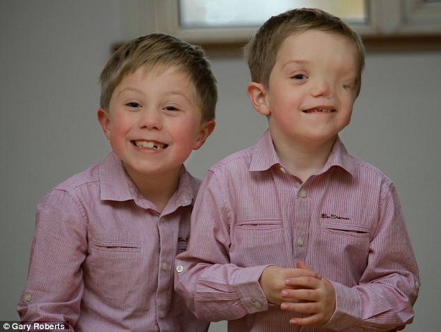 The 33-year-old British mother Charlene Machin had given birth to twin boys Oliver and Harry, but doctors discovered baby Harry had been born with a severe facial deformity, according to newspaper Daily Mail. Charlene and her two sons have overcome other people's prejudices and are a loving, close family. (Photo Source: huanqiu.com)