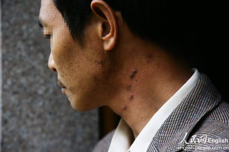 Obvious herpes appear on Bing's body since last year, April 3, 2013, Nan'an City, Fujian. (CFP/Pan Deng)