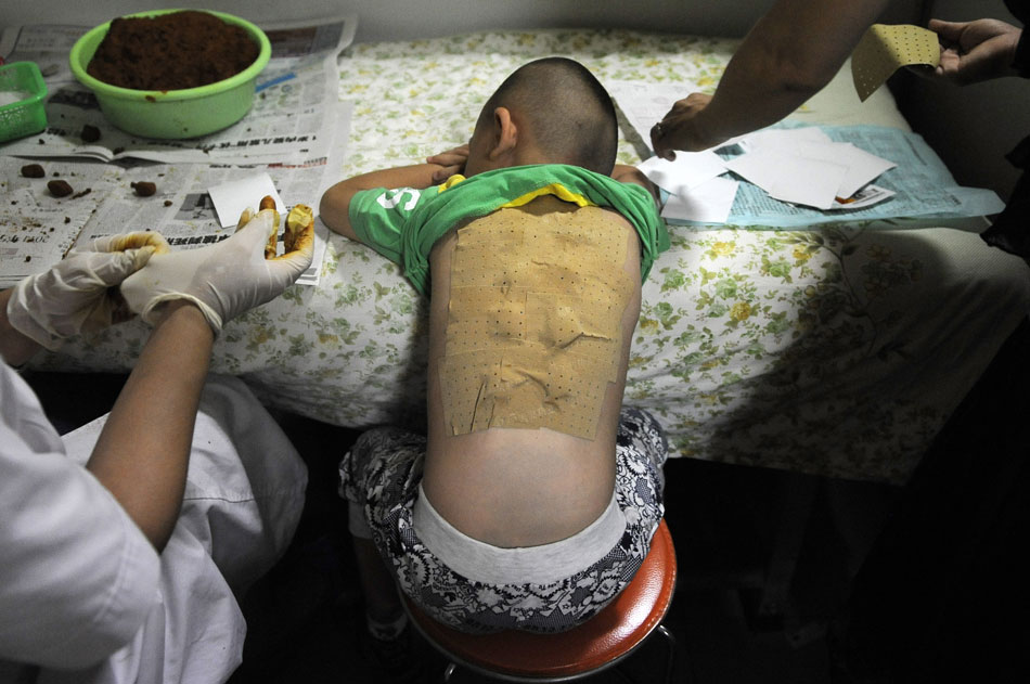 A child receives sticking therapy in Chinese Medicine Hospital of Ningxia Medical University, July 13, 2013. Sticking therapy is a traditional medical treatment in China. Applying the plasters on acupuncture points in the hottest days in summer would help enhance disease resistance and prevent diseases in summer. (Xinhua/Li Ran)