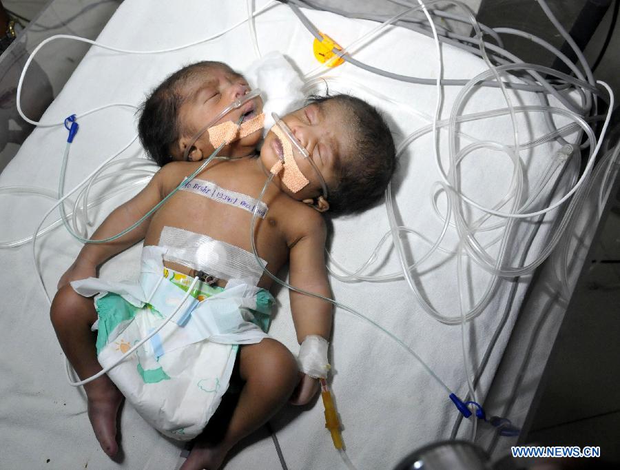 A newly-born two-head baby sleeps at a hospital in Jaipur, India, July 25, 2013. Doctors said it would the first case of its kind in the state and the 3rd such case in India. (Xinhua/Stringer)