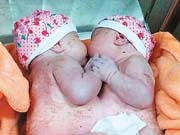 Conjoined twins separated in groundbreaking surgery in Guangxi, SW China 
