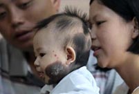 Baby girl 'too young' for birthmarks treatment