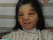Girl smiles after face transplant in SE China