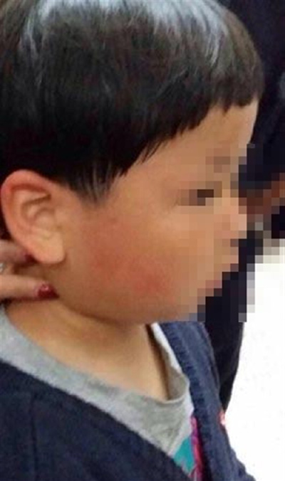 The six-year-old boy is left with a swollen face after a foreign woman slapped him for scraping against her when playing with a trolley in the baggage claim area at Shanghai Pudong International Airport yesterday. --photo by witness (Shanghai Daily)