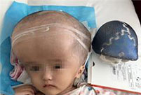Doctors use 3D-printed skull to save girl